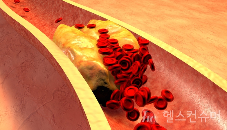 맛은 있다, 하지만 당신의 혈관은 좀 곤란할 것이다, 사진제공: 게티이미지코리아