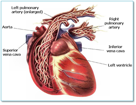 4기 이상으로 성장한 심장사상충에 감염된 심장 해부도
