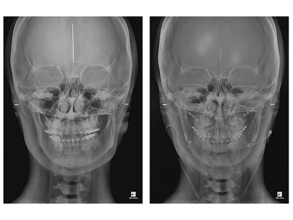 안면비대칭 수술 전(왼쪽)과 후(오른쪽) 방사선 사진.