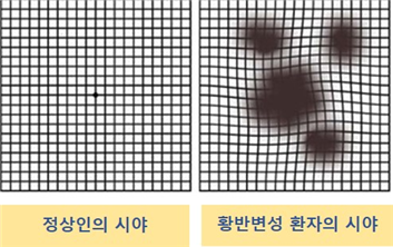 □ 정상인과 황반변성 환자의 시야<br>